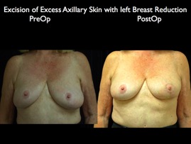 BreastLift2012.023.jpg