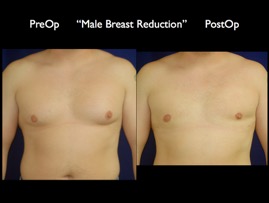 Breast Reduction.004.jpg
