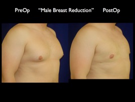 Breast Reduction.005.jpg