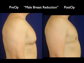 Breast Reduction.006.jpg