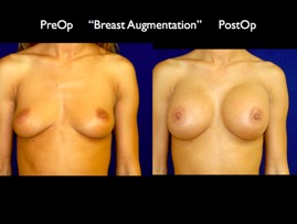 Breast-Aug.001.jpg