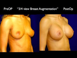 Breast-Aug.002.jpg