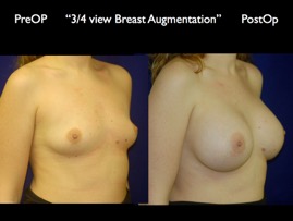 Breast-Aug.041.jpg