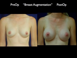 Breast-Aug.043.jpg