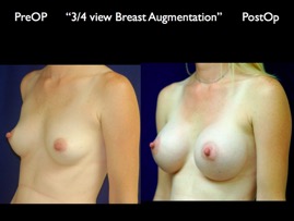 Breast-Aug.044.jpg