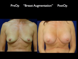 Breast-Aug.049.jpg