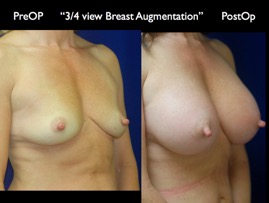 Breast-Aug.050.jpg