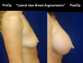 Breast-Aug.051.jpg