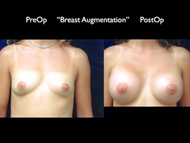 Breast-Aug2.001.jpg