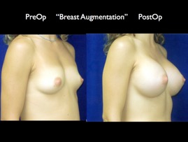 Breast-Aug2.002.jpg