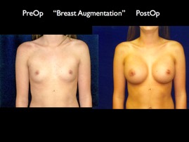 Breast-Aug2.007.jpg