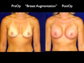 Breast-Aug2.014.jpg