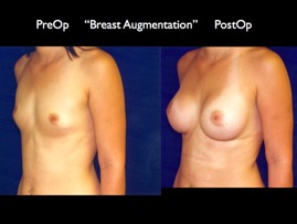Breast-Aug2.016.jpg