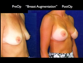 Breast-Aug2.019.jpg
