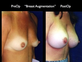 Breast-Aug2.021.jpg