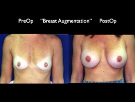 Breast-Aug2.022.jpg