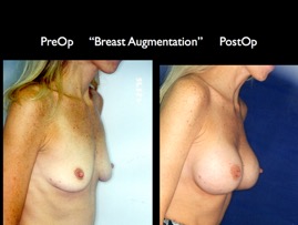 Breast-Aug2.023.jpg
