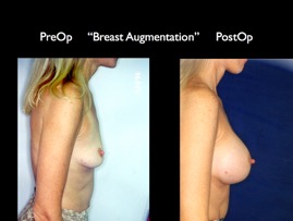 Breast-Aug2.025.jpg