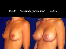 Breast-Aug2.026.jpg