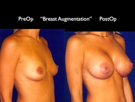 Breast-Aug2.027.jpg