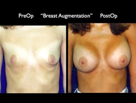 Breast-Aug2.039.jpg