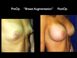 Breast-Aug2.040.jpg