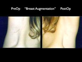 Breast-Aug2.042.jpg