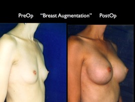 Breast-Aug2.044.jpg