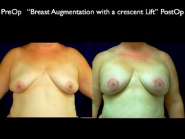 Breast-Aug.004.jpg