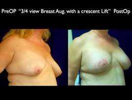 Breast-Aug.005.jpg