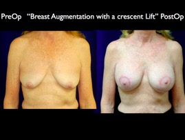 Breast-Aug.007.jpg