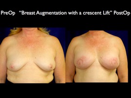 Breast-Aug.010.jpg