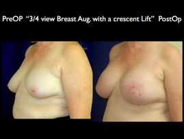 Breast-Aug.011.jpg