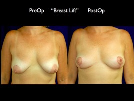 BreastLift.004.jpg