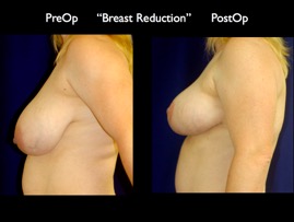 Breast Reduction.003.jpg