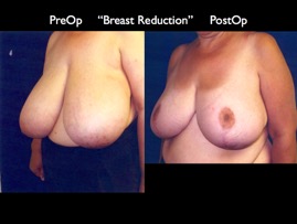BreastReduc2.001.jpg