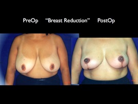 BreastReduc2.005.jpg