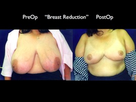 BreastReduc2.009.jpg