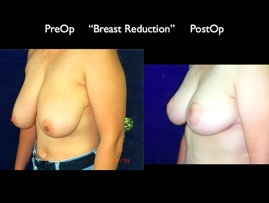BreastReduc2.010.jpg