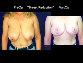BreastReduc2.011.jpg