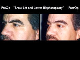 BrowLift2.001.jpg