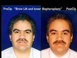 BrowLift2.002.jpg