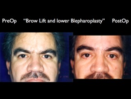 BrowLift2.003.jpg