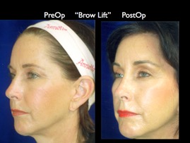 BrowLift2.004.jpg