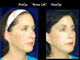 BrowLift2.005.jpg