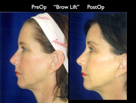 BrowLift2.006.jpg