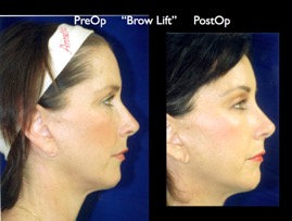 BrowLift2.007.jpg