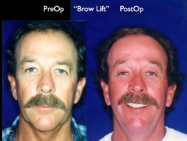 BrowLift2.008.jpg