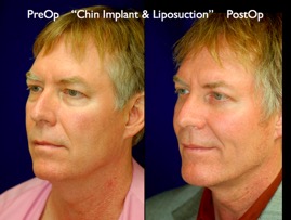 FacLift.005.jpg