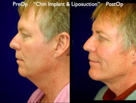 FacLift.006.jpg